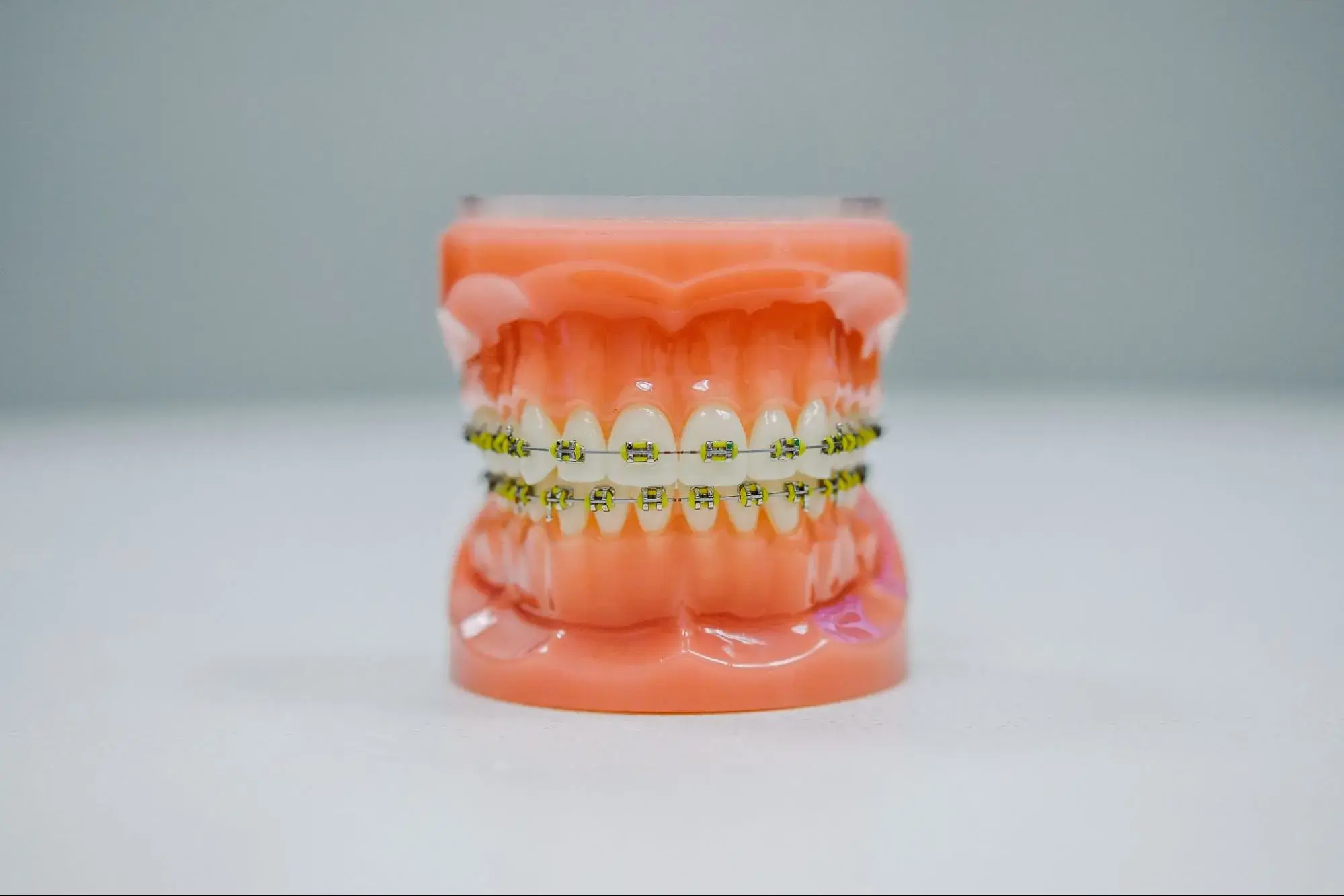 Plastic teeth mold with braces attached.