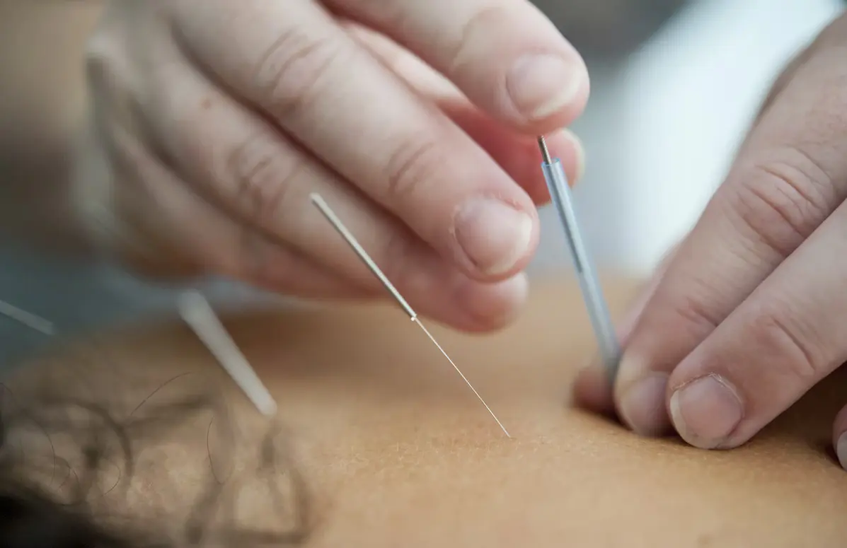 A person receiving acupuncture for chronic back pains and is covered by Medicare.