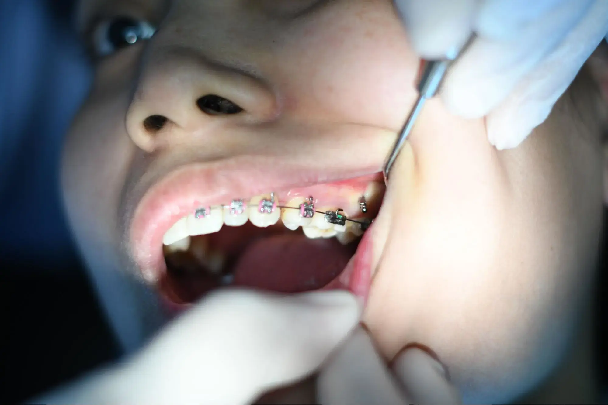 A person getting braces put in.
